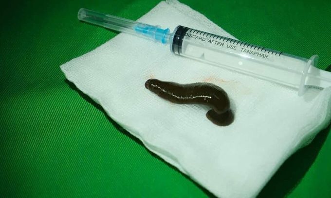 Man with Hoarse Voice Finds Leech Attached to His Throat